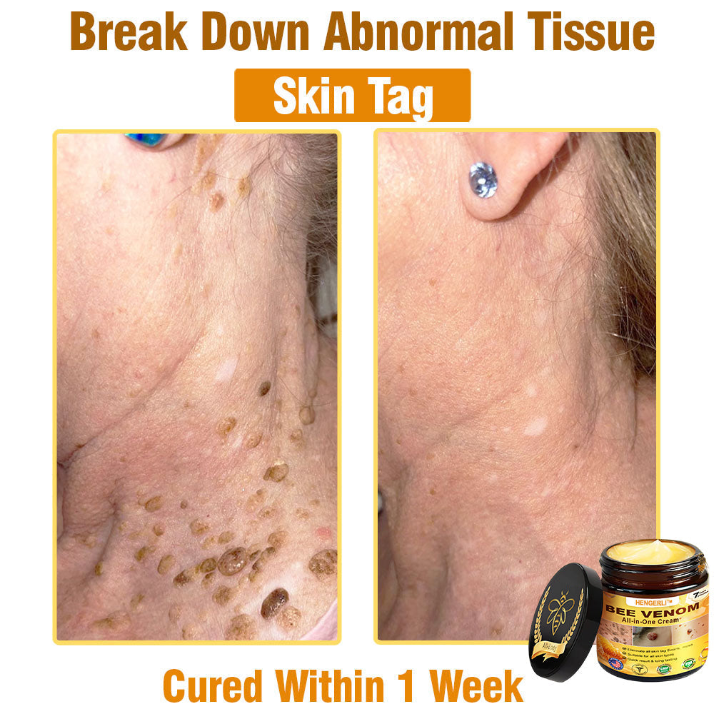 HENGERLI™ Bee Venom All-in-One Cream US Dermatologist Approved🥑