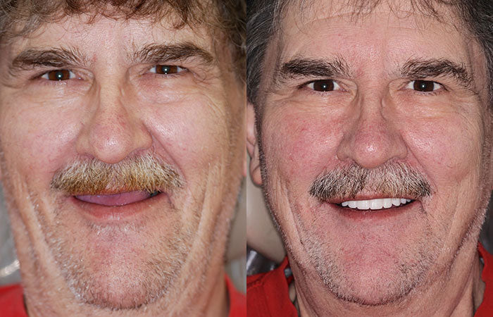 Custom-Fit Functional Dentures🦷