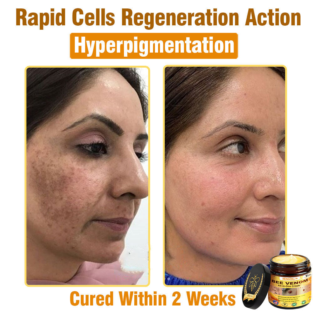HENGERLI™ Bee Venom All-in-One Cream US Dermatologist Approved🥑
