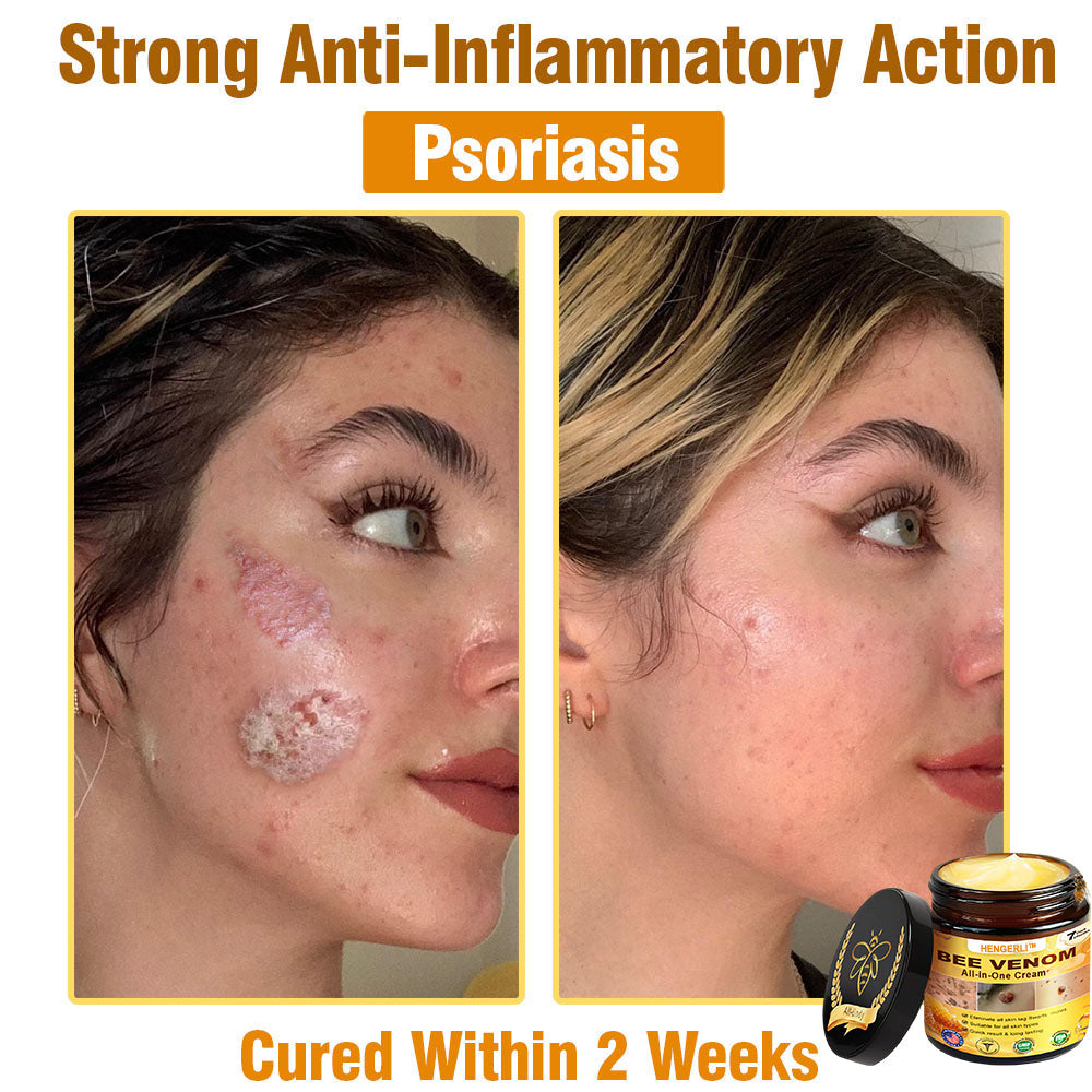 HENGERLI™ Bee Venom All-in-One Cream US Dermatologist Approved🥑