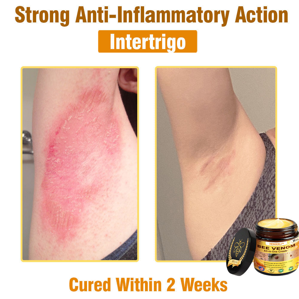 HENGERLI™ Bee Venom All-in-One Cream US Dermatologist Approved🥑