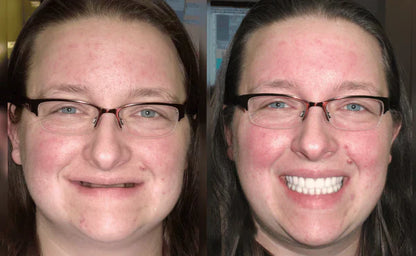Custom-Fit Functional Dentures🦷