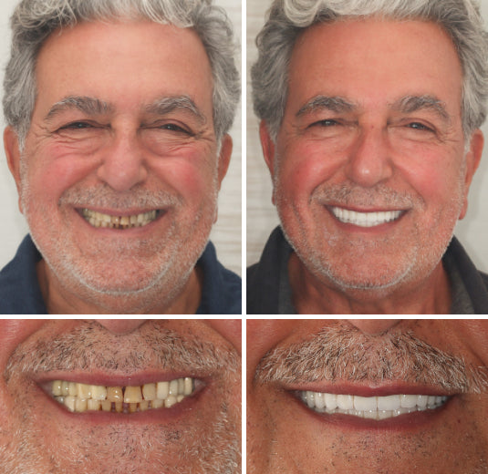 Custom-Fit Functional Dentures🦷