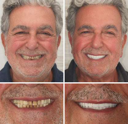 Custom-Fit Functional Dentures🦷